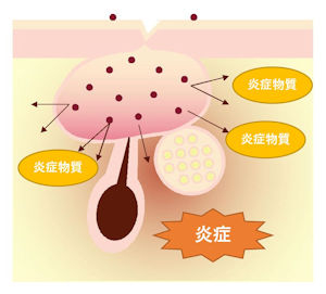 ニキビの原因と対策 品川区のあおよこ皮膚科クリニック